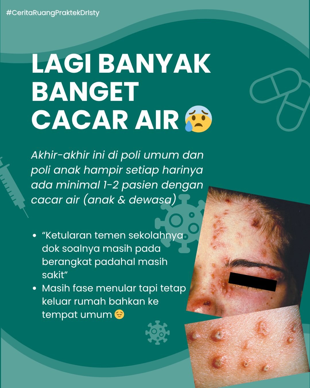 Lagi Banyak Banget Cacar Air